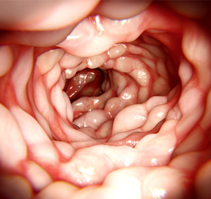 maladie de crohn